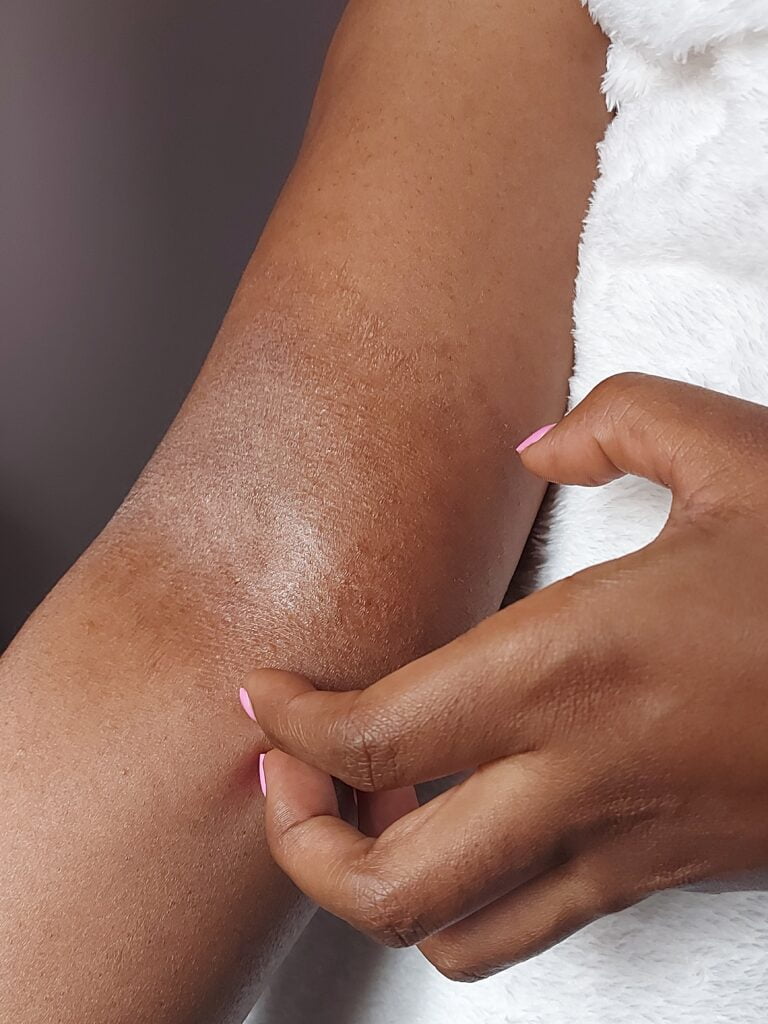 Eczema Management | Choosing the best cream-Swiftly Found